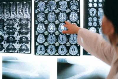Possible Breakthrough with Alzheimer Treatment 